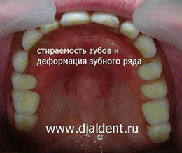 изношенный зубной протез