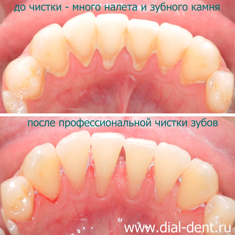 внутренняя поверхность зубов до и после профессиональной чистки в Диал-Дент