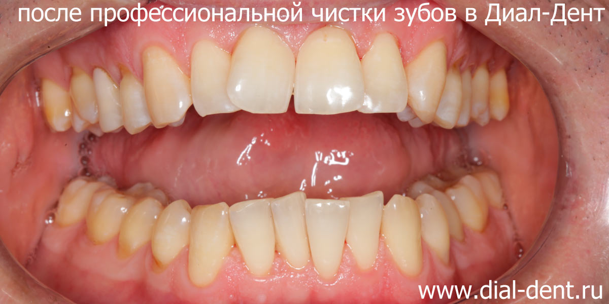  чистые зубы после работы гигиениста