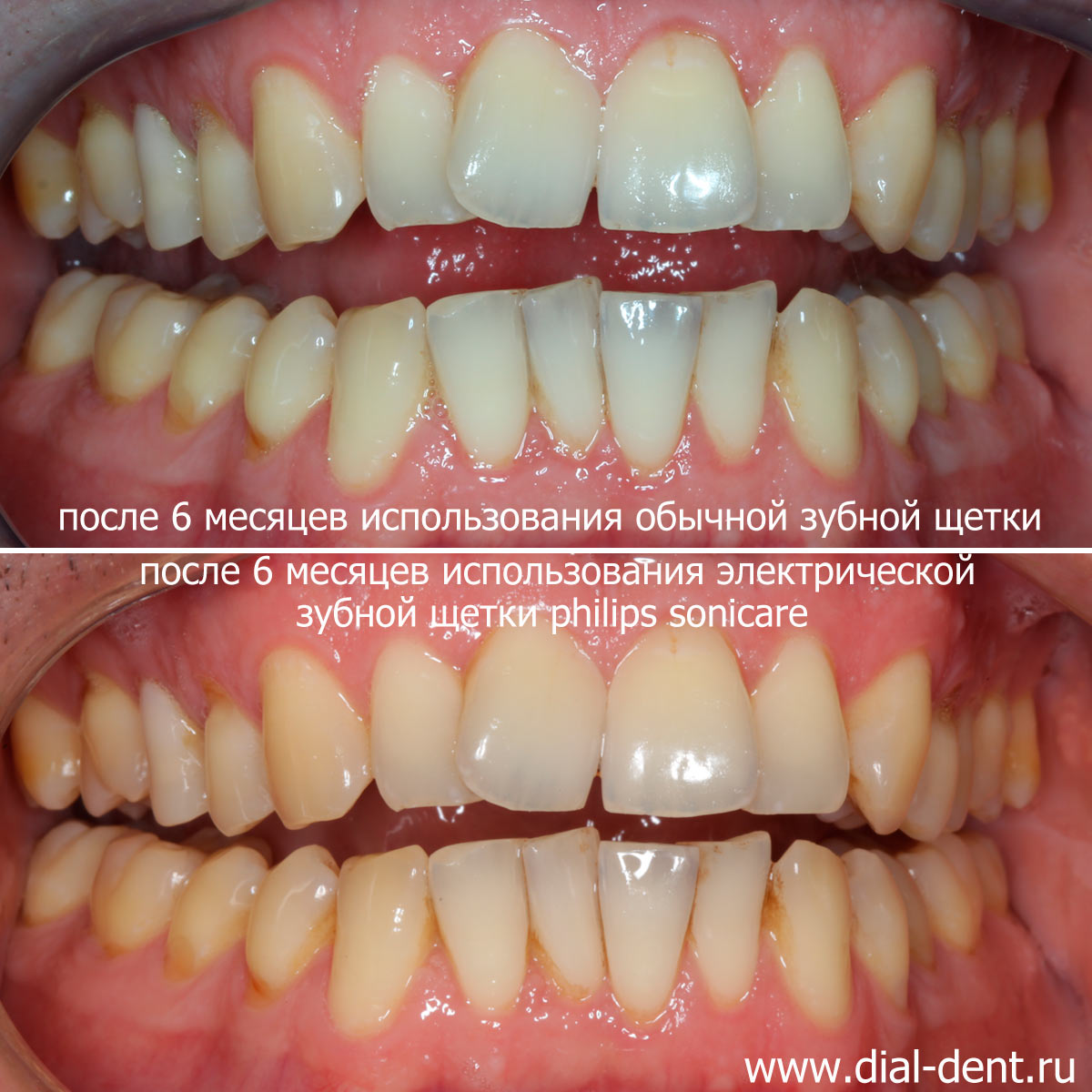 сравнение эффективности чистки зубов обычной и электрической звуковой зубной щеткой