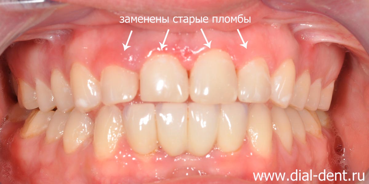 реставрация передних зубов после замены старых пломб