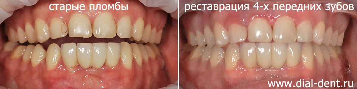 передние зубы до и после реставрации