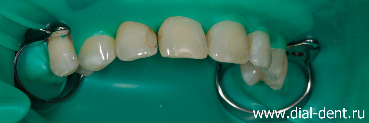 коффердам используется для повышения качества реставрации зубов