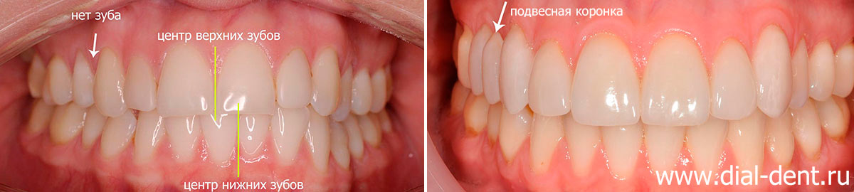 вид зубов до и после лечения
