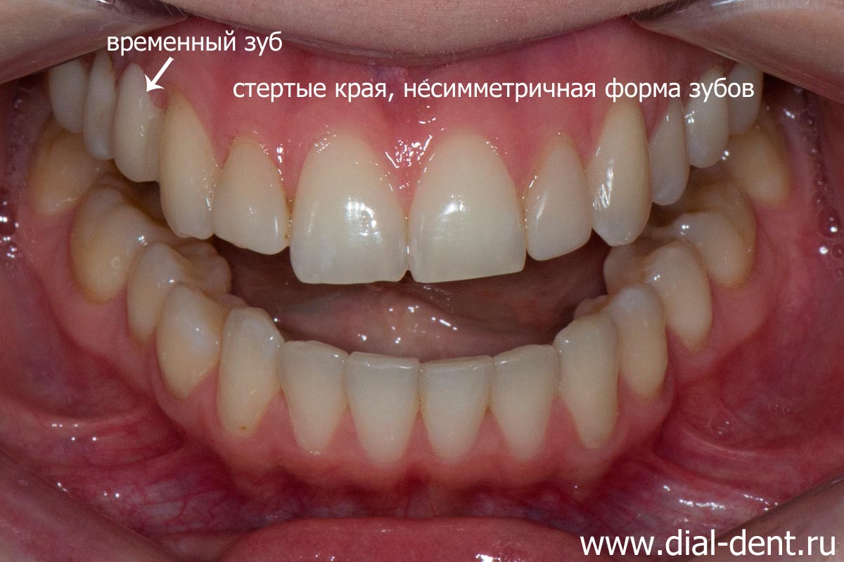 после ортодонтического лечения требуется восстановление эстетики и протезирование отсутствующего зуба