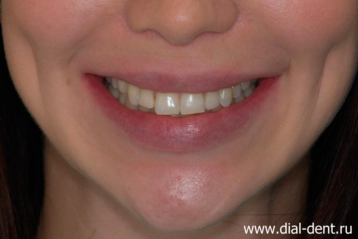 после ортодонтического лечения требуется восстановление эстетики зубов