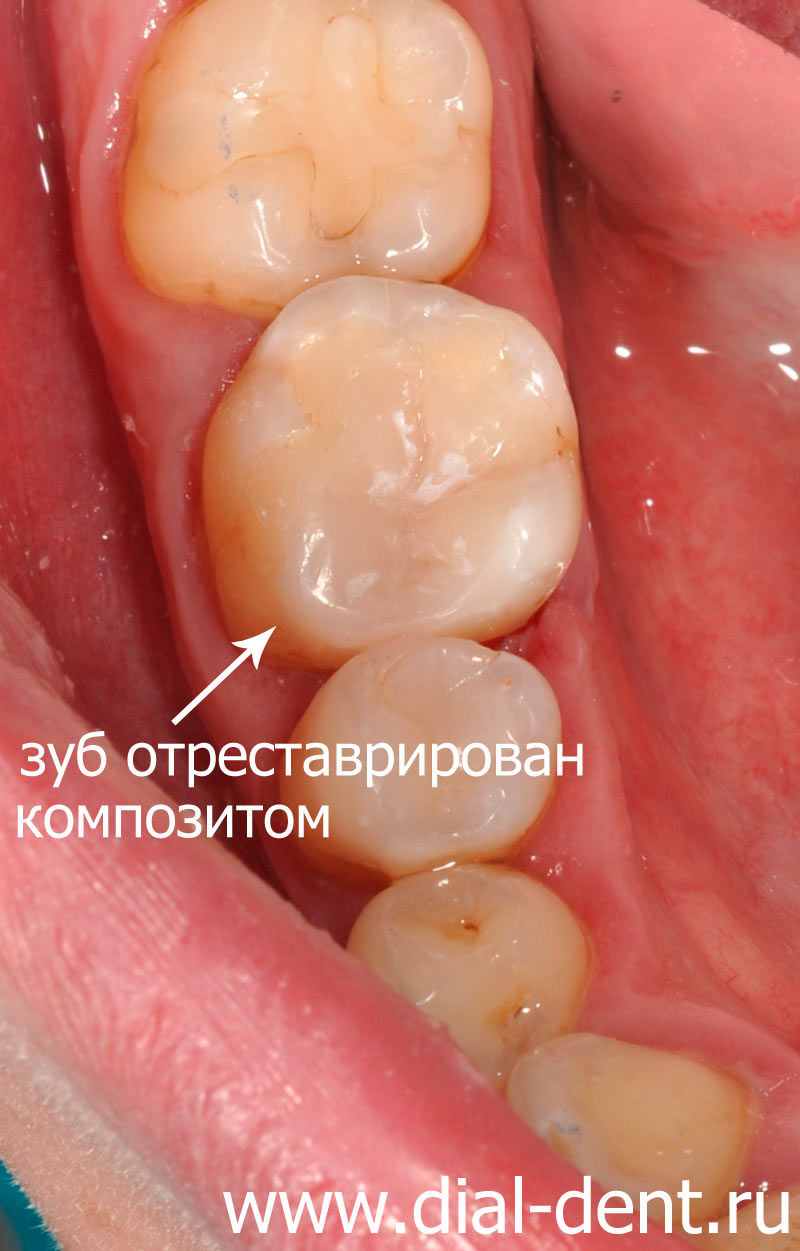после лечения пульпита с микроскопом зуб восстановлен композитом