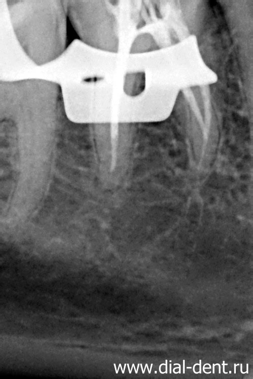 каналы зуба запломбированы гуттаперчей