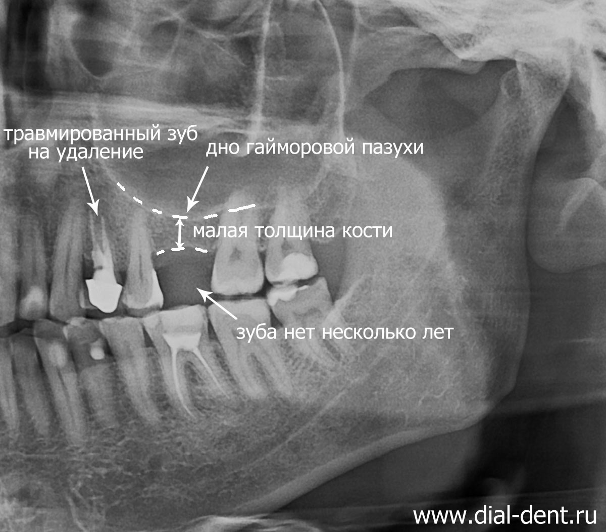 рентгеновский снимок перед имплантацией верхних зубов