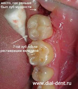 реставрация вкладкой кариозной полости в 7 зубе