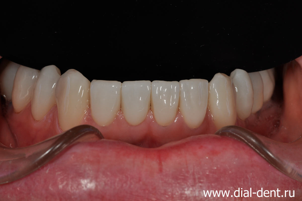 вид нижних зубов после комплексного лечения, имплантации и протезирования зубов
