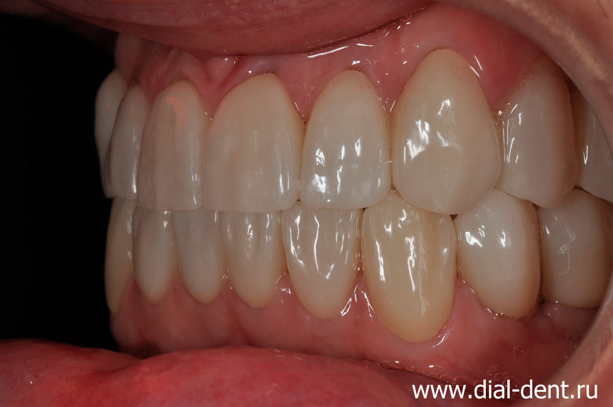вид зубов слева после комплексного лечения, имплантации и протезирования зубов
