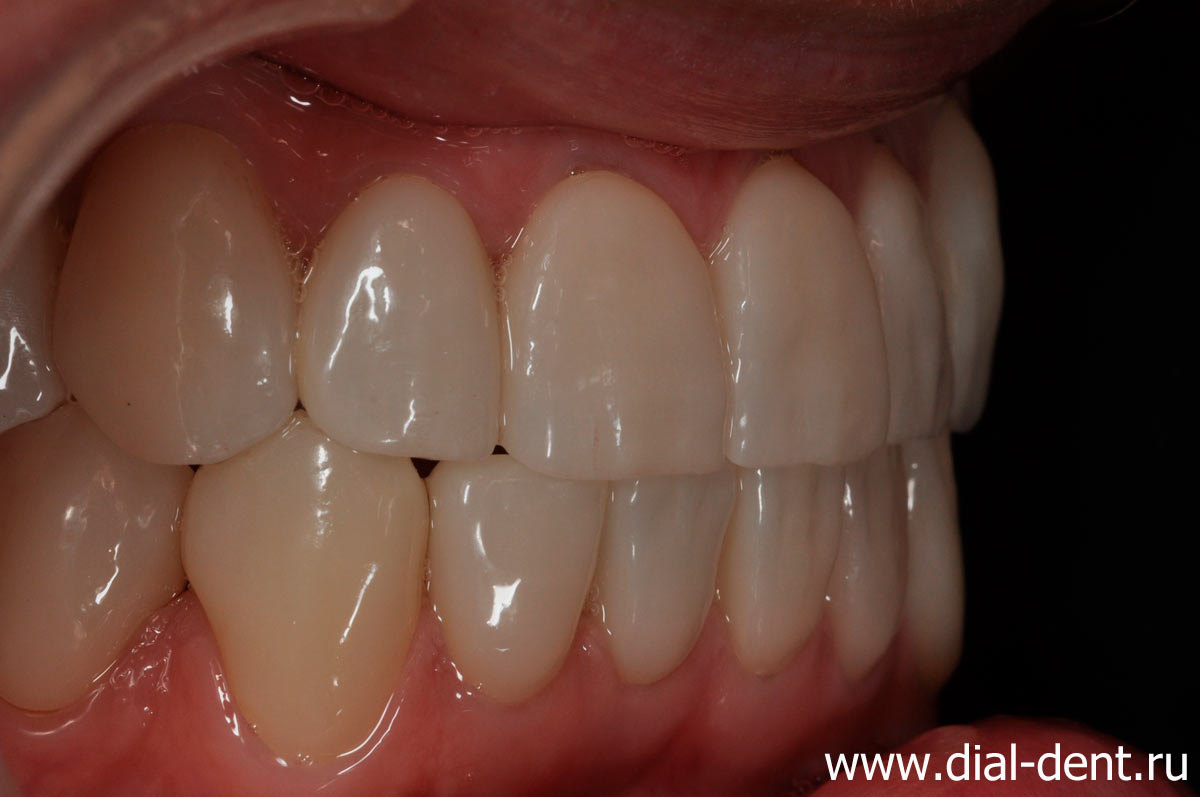 вид зубов справа после комплексного лечения, имплантации и протезирования зубов