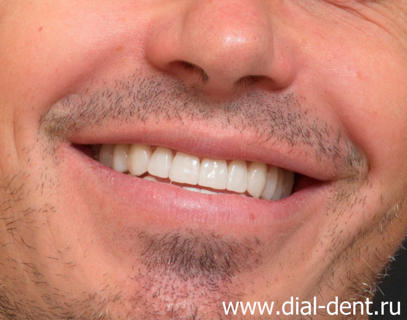 улыбка после комплексного лечения, имплантации и протезирования зубов
