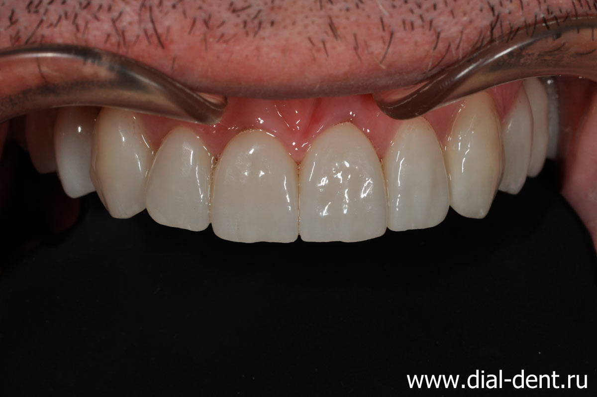 вид верхних зубов после комплексного лечения, имплантации и протезирования зубов