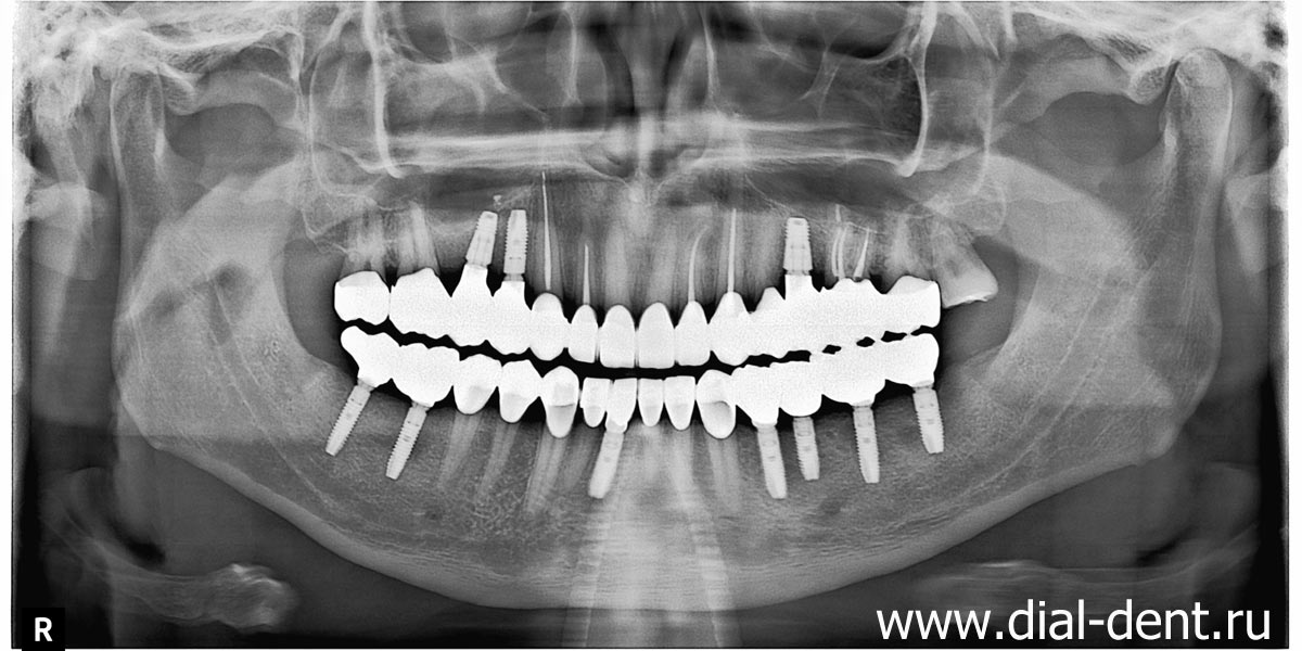 панорамный снимок зубов после комплексного лечения, имплантации и протезирования зубов