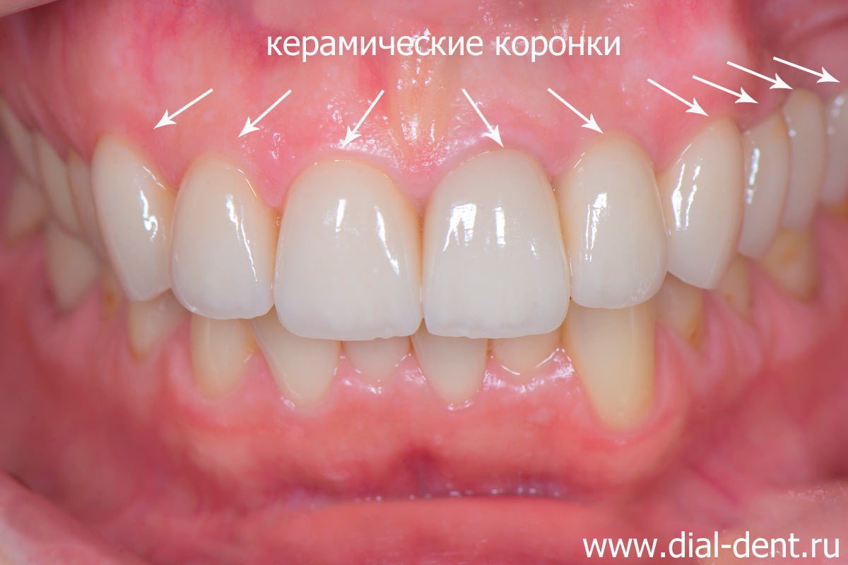 протезирование зубов, в том числе протезирование на имплантах