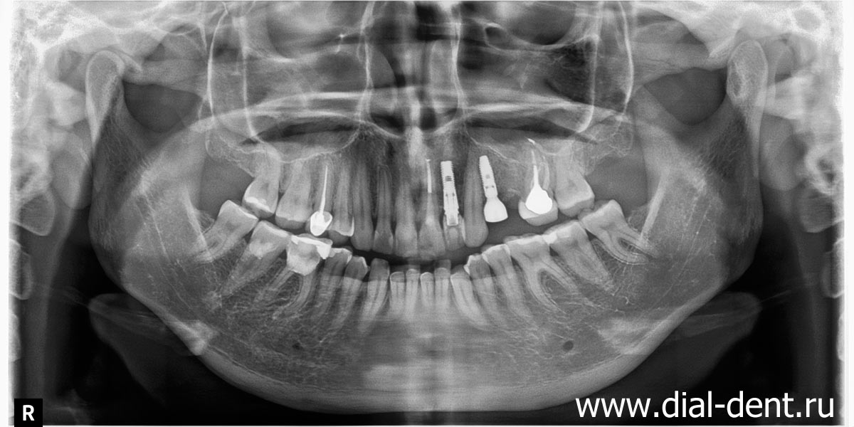 панорамный снимок зубов после имплантации и лечения каналов