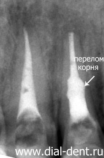 рентген зуба показал перелом корня