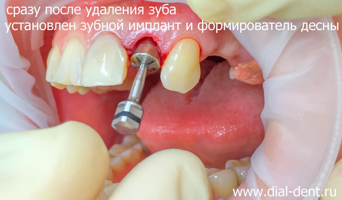 имплант зуба с формирователем десны
