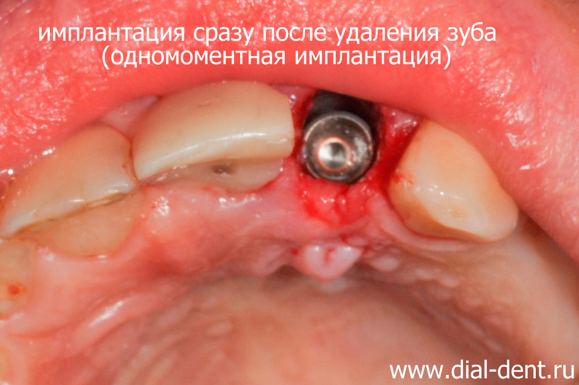 одномоментная имплантация зуба (зубной имплант Astra Tech)