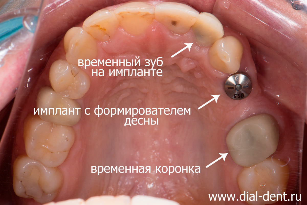 вид верхних зубов после имплантации и лечения каналов