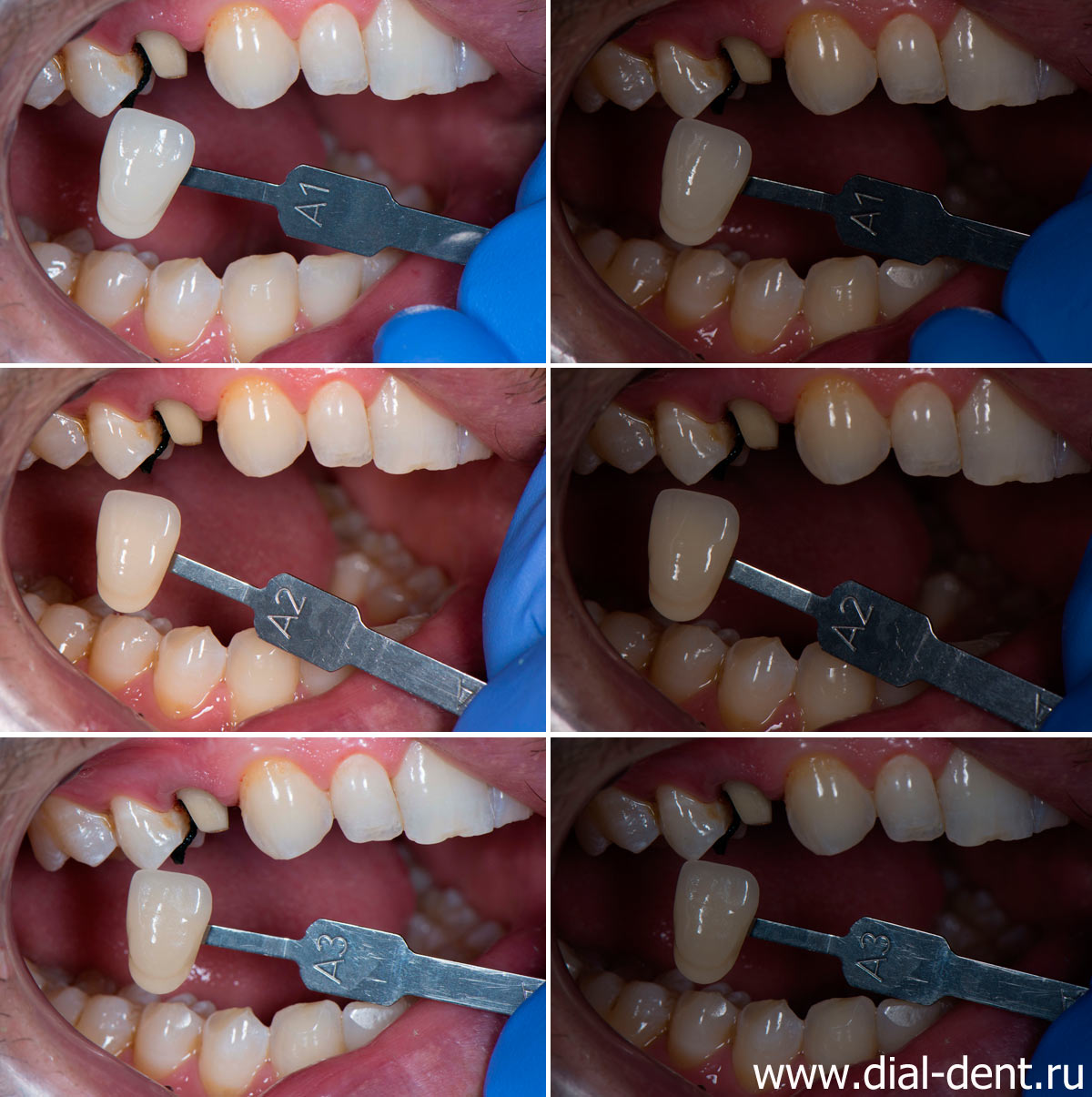 подбор цвета при протезировании зубов