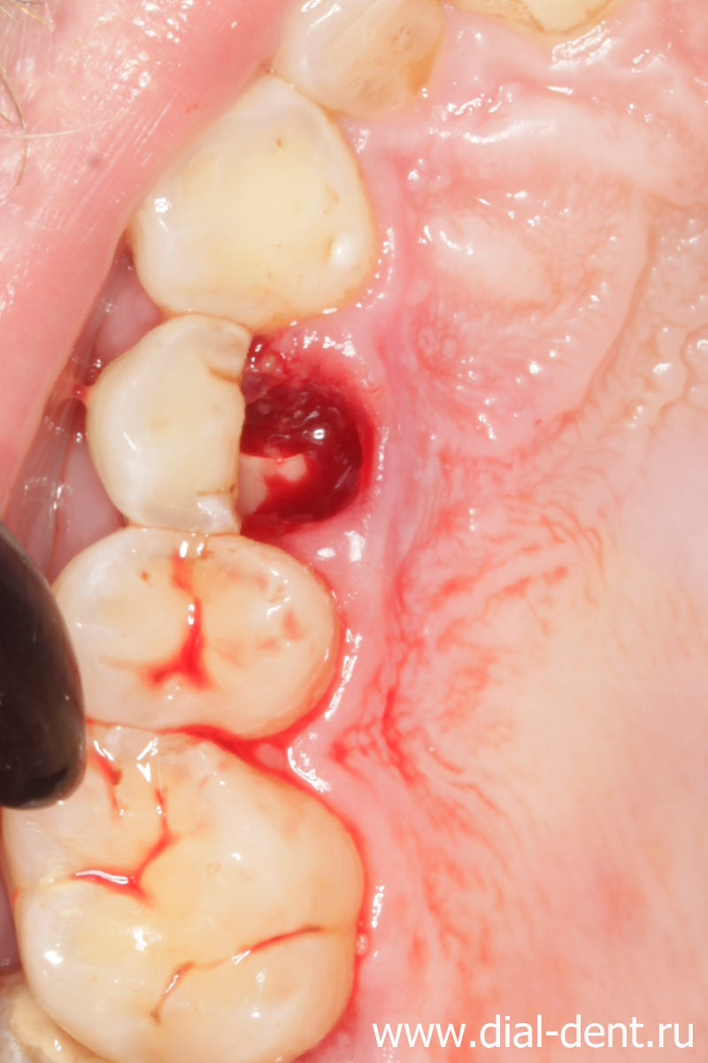 удалена отколовшаяся часть зуба