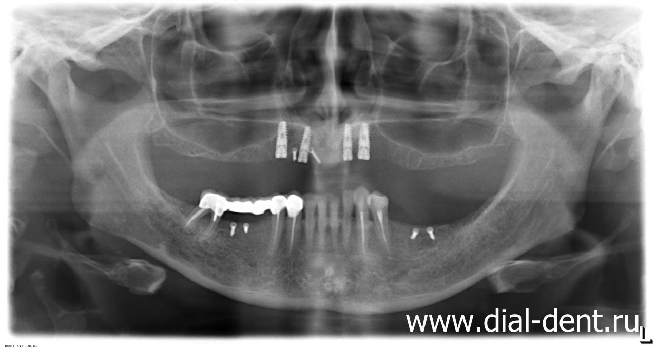 панорамный снимок зубов после установки зубных имплантов взамен передних зубов