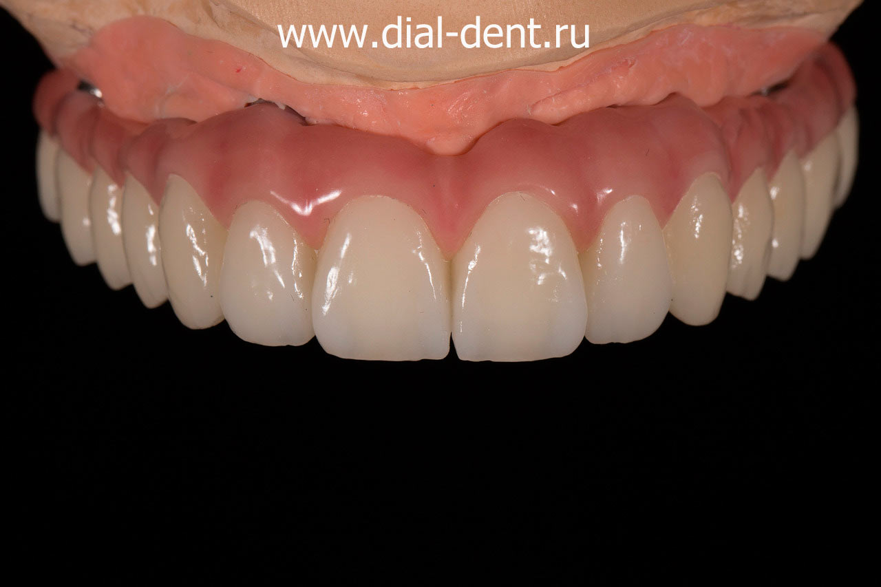 полный протез верхних зубов на имплантах