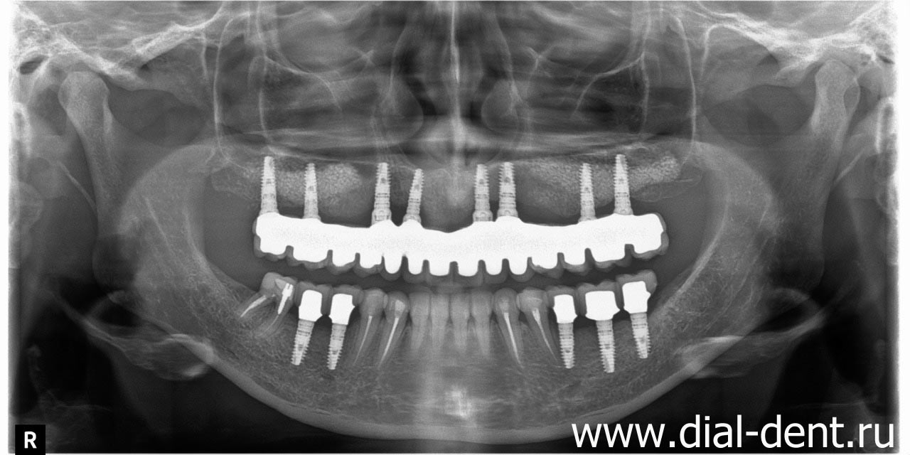 панорамный снимок зубов после лечения и протезирования в Диал-Дент