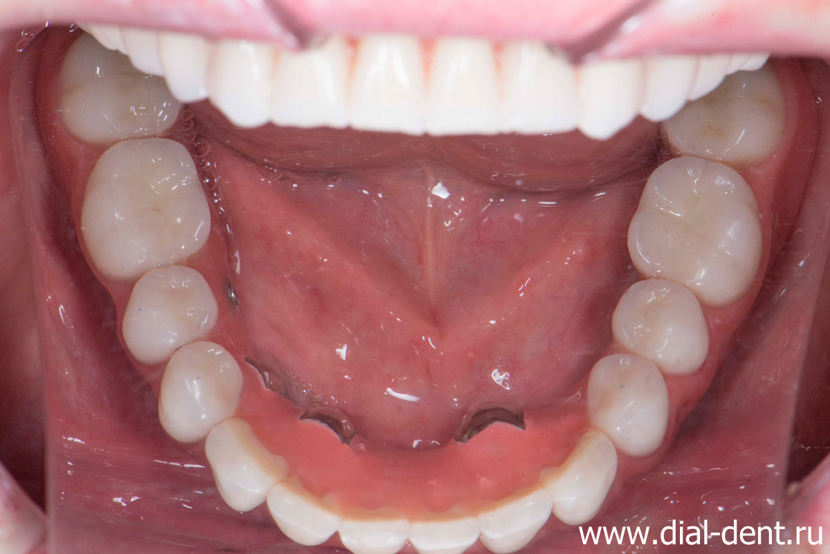 съемный зубной протез нижней челюсти с креплением на имплантах
