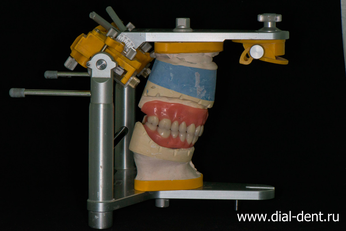 съемные зубные протезы - технические этапы