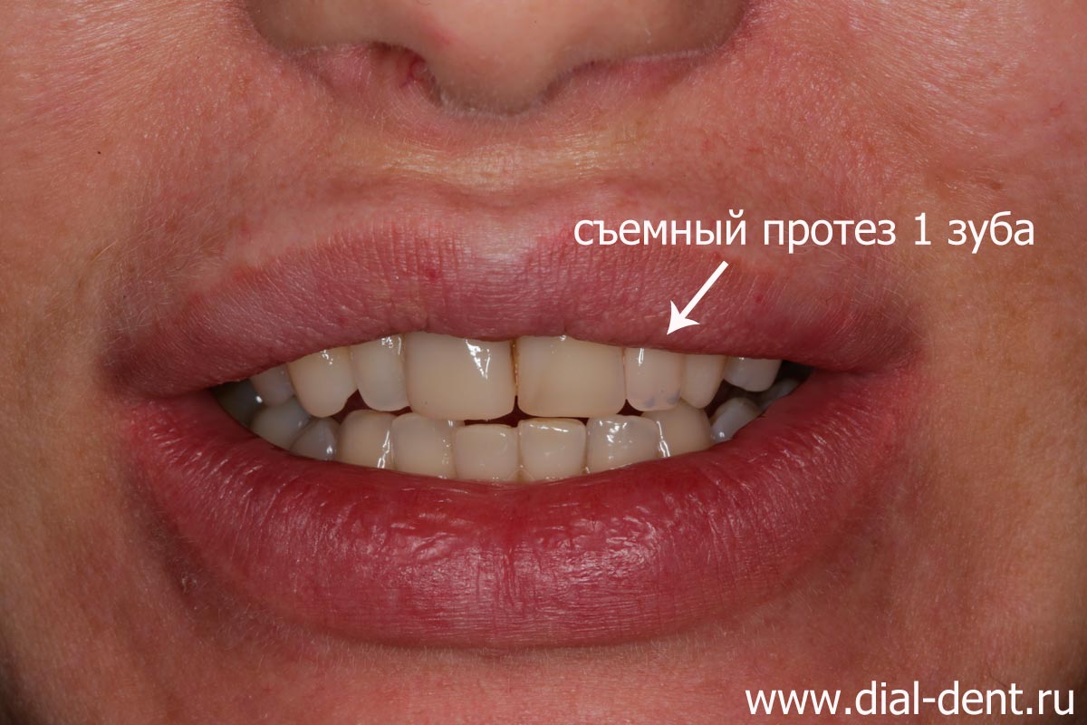 Как скрыть отсутствие переднего зуба Реставрация молочных зубов Томск Хлебосольный