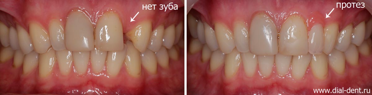 недостающий зуб восстановлен съемным минипротезом