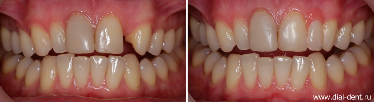 недостающий зуб восстановлен съемным минипротезом
