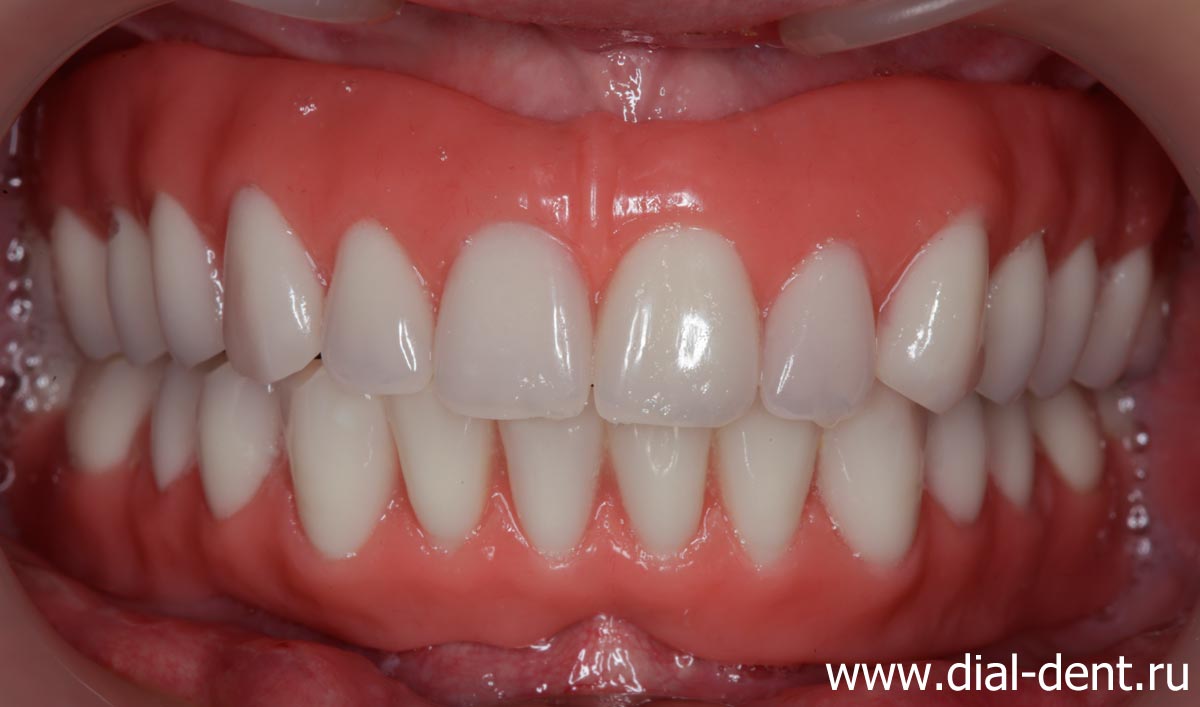 полные зубные протезы на имплантах - современное съемное протезирование зубов