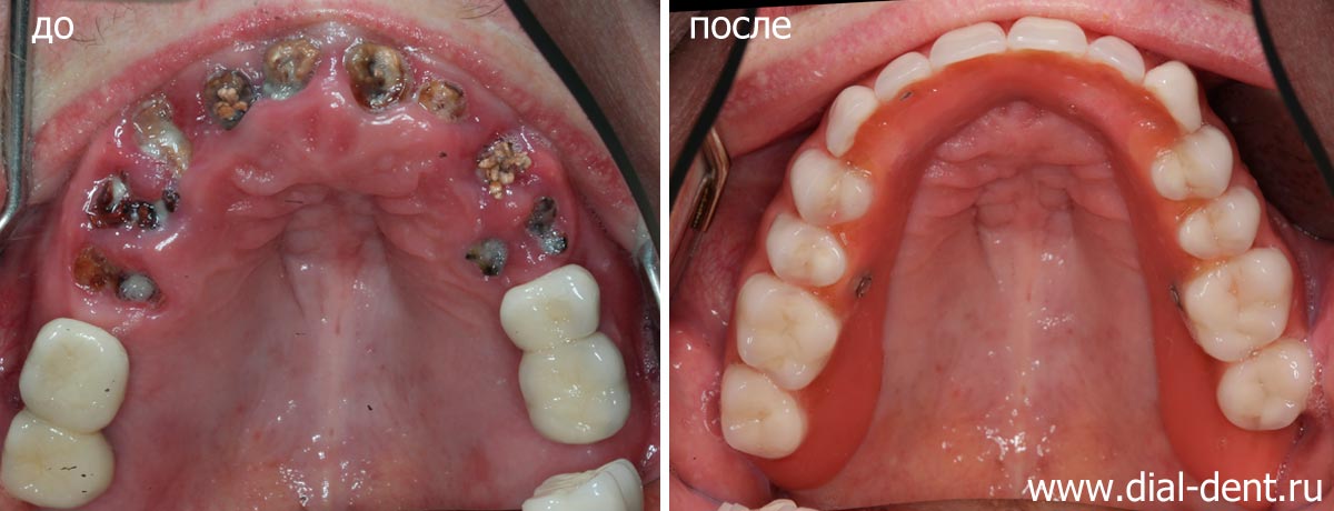 верхние зубы до и после протезирования на имплантах