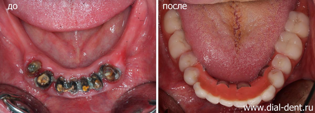 нижние зубы до и после протезирования на имплантах