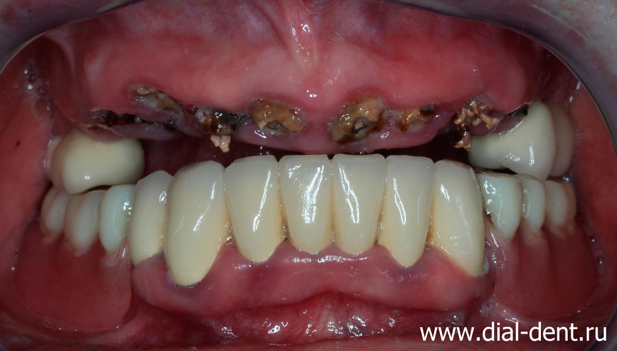 пациентка пришла с острой проблемой - отвалился протез верхних зубов