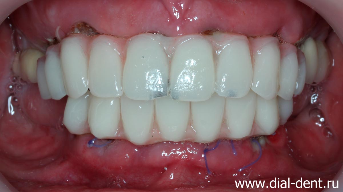 временные зубные протезы установлены сразу после имплантации