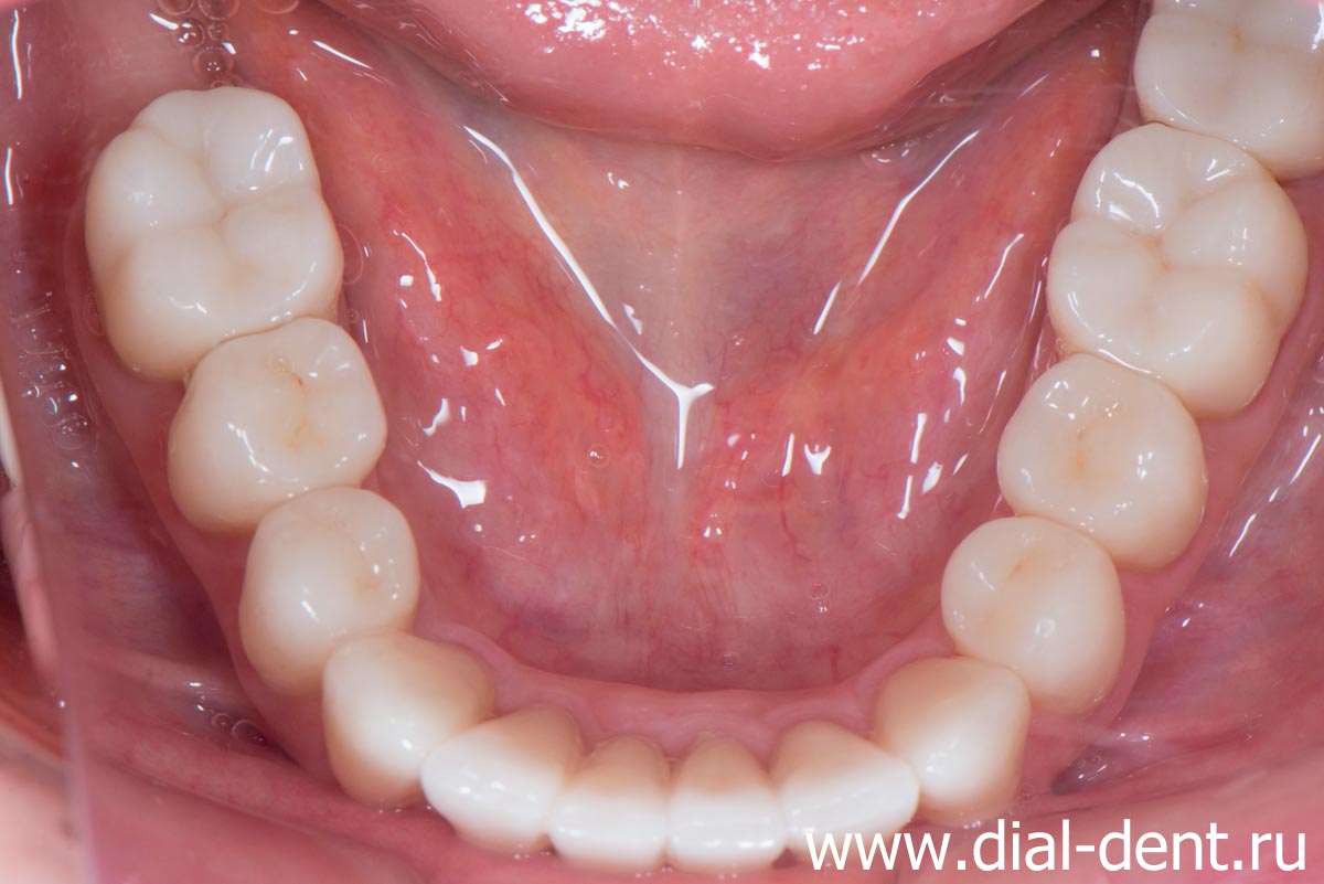 результат протезирования зубов в Диал-Дент - нижние зубы
