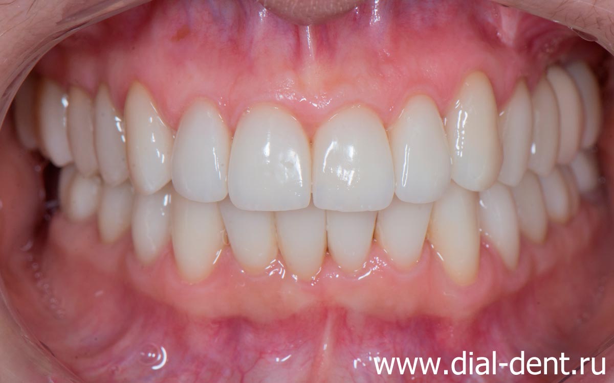 вид зубов после исправления прикуса, лечения и протезирования зубов
