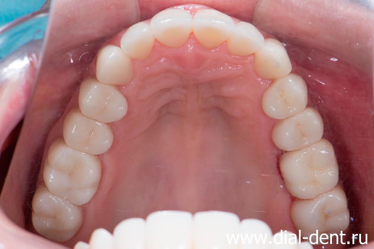 результат протезирования зубов в Диал-Дент - верхние зубы