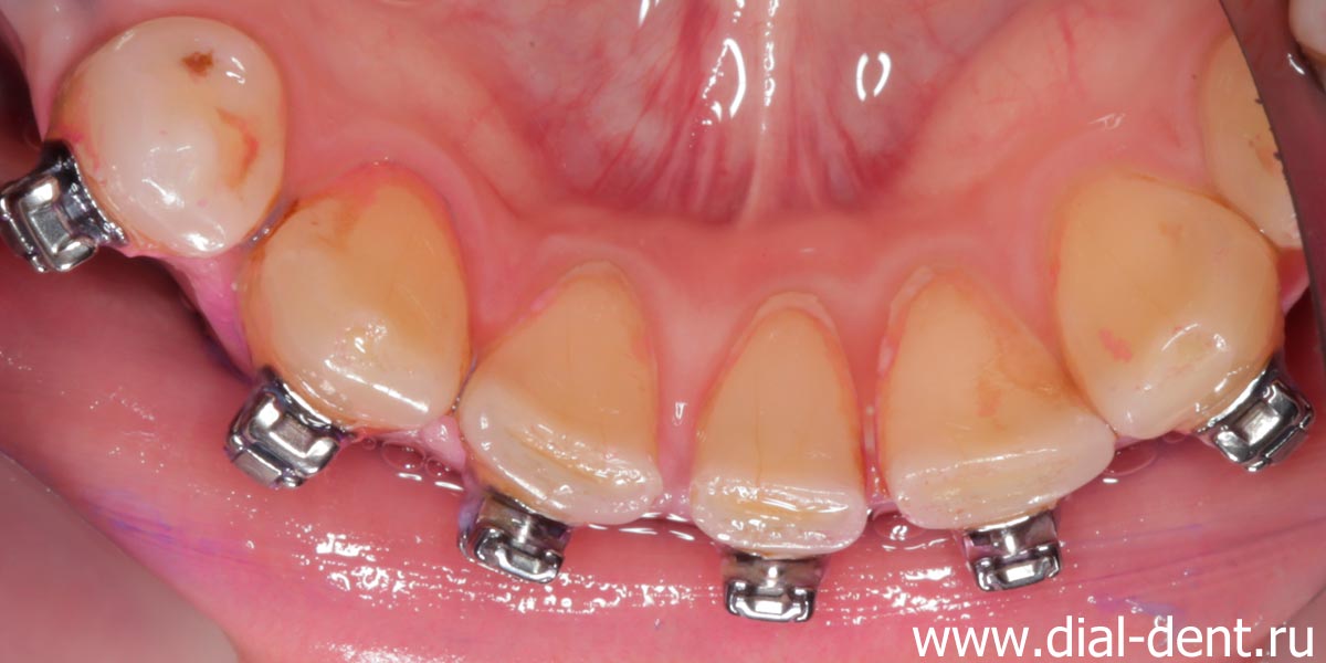 отложения на внутренней поверхности зубов вызывают запах изо рта