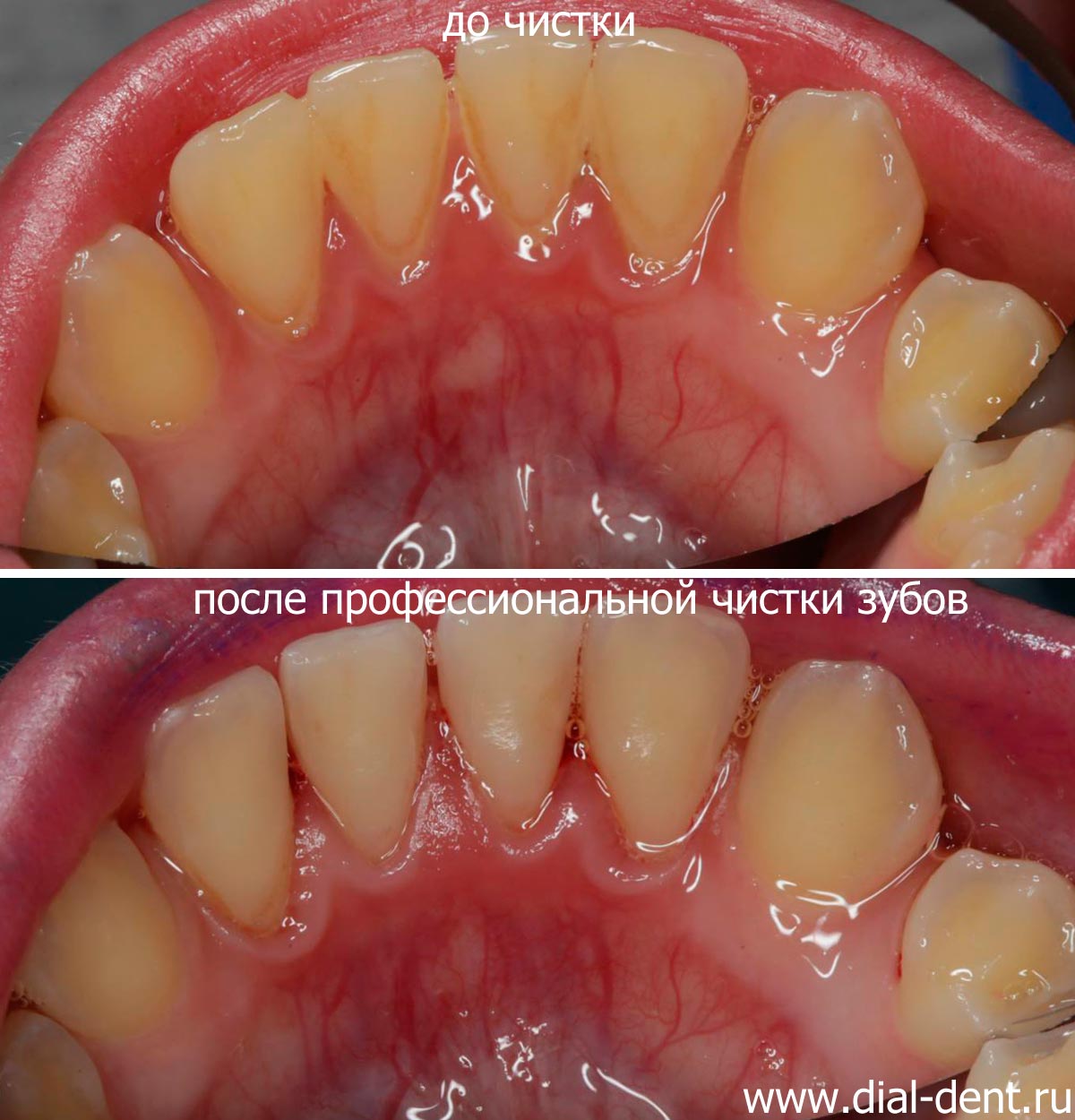 до и после профессиональной чистки зубов у ребенка 11 лет