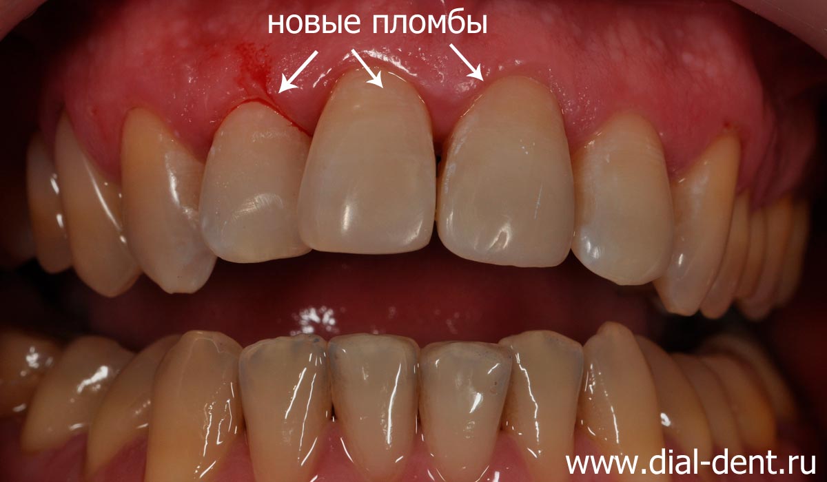 реставрация передних зубов после лечения кариеса