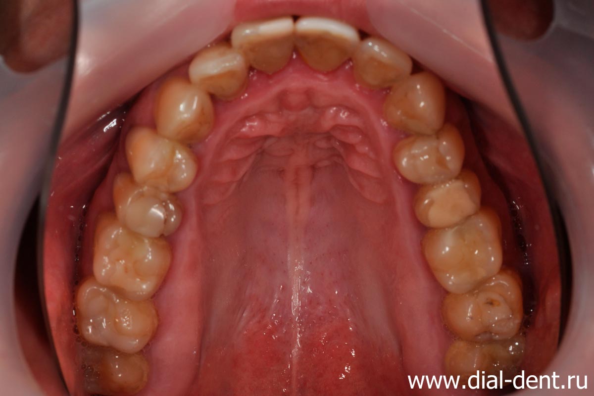 на зубах старые пломбы, кариес, требуется комплексное лечение