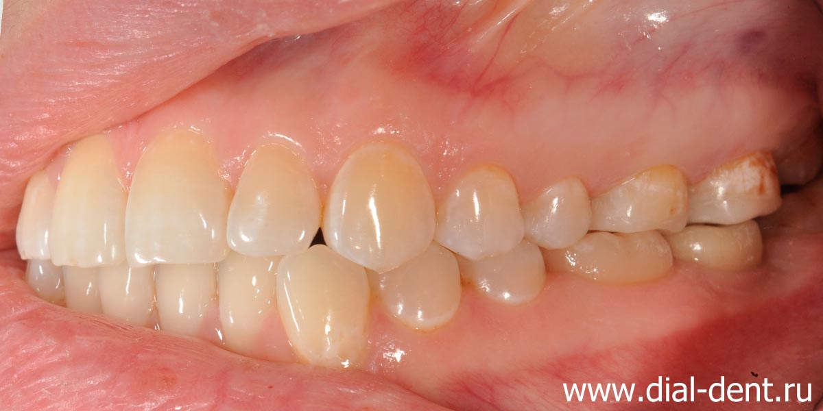 жевательные зубы восстановлены вкладками