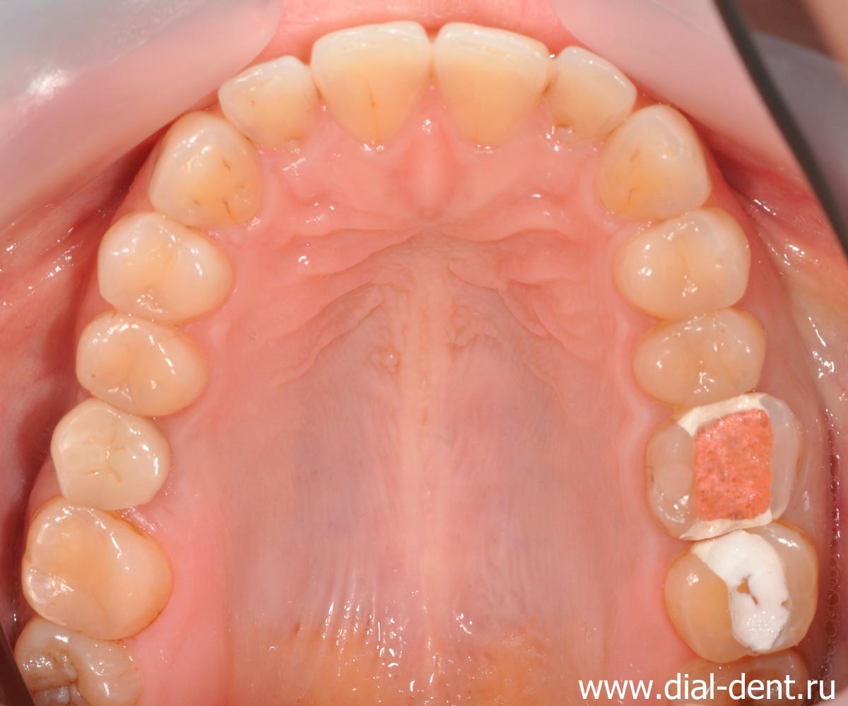 вид при обращении с острой болью в зубе (проблемный зуб под розовой пломбой)